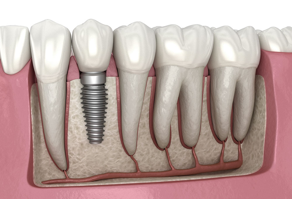 Diş İmplantı (Dental Implant)