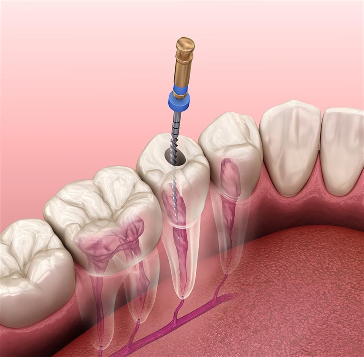 Kanal Tedavisi (Endodonti)